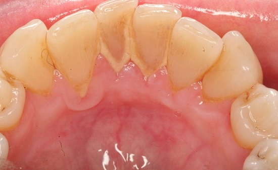 Tại sao phải lấy vôi răng định kỳ tại các phòng khám nha khoa?