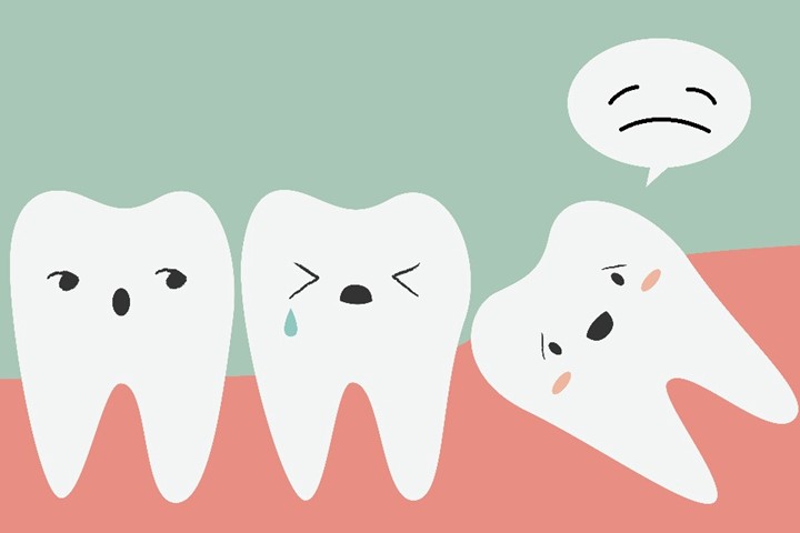 Khi răng khôn mọc lệch bị những tác hại gì?