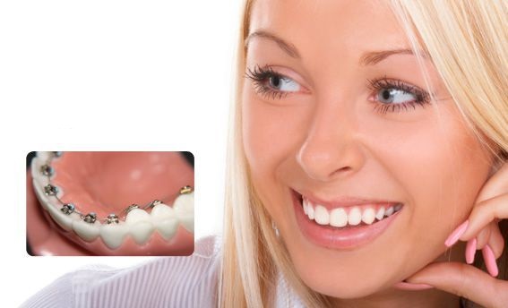 Niềng răng không cần nhổ răng được áp dụng khi nào?