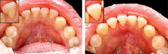 Tại sao phải lấy vôi răng định kỳ tại phòng khám nha khoa?