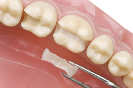 Kỹ thuật trám răng Inlay/Onlay phục hồi răng hư tổn