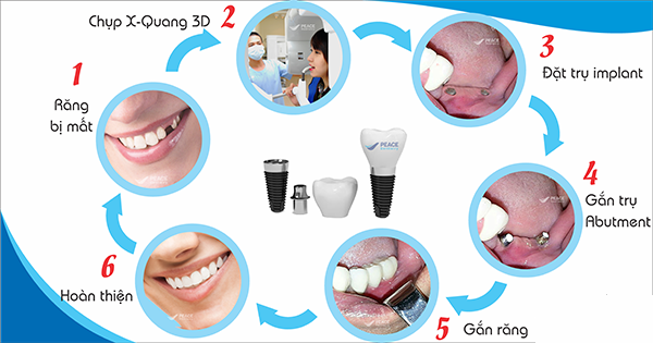 Quy trình và cách chăm sóc răng sau khi cắm ghép Implant