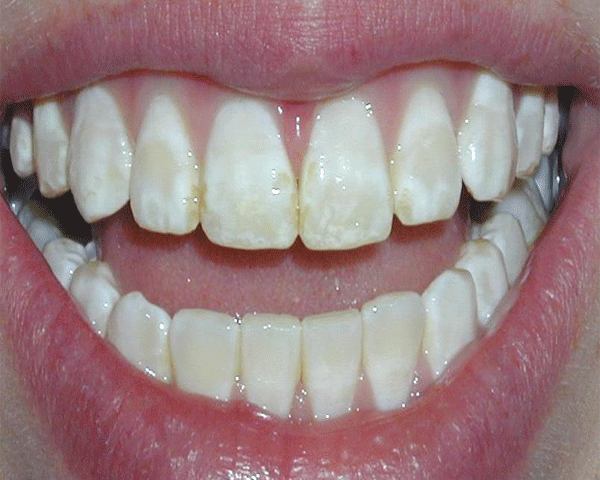 Điều trị răng nhiễm fluor thế nào?