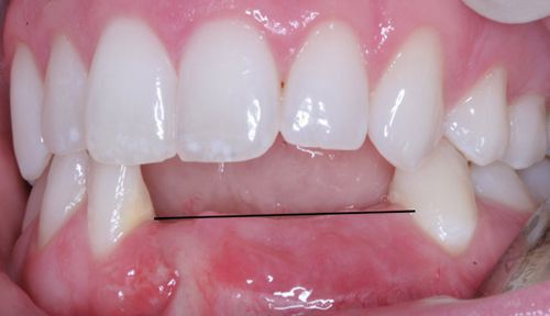 Sau nhổ răng bao lâu thì nên trồng lại răng