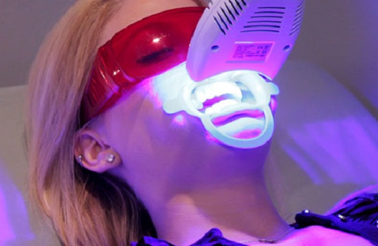 Vì sao Công nghệ tẩy trắng răng Laser Whitening lại có chi phí điều trị cao?