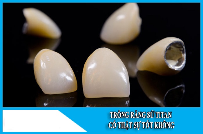 Tìm hiểu về răng sứ Titan