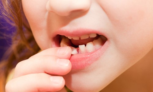 Cần làm gì khi răng bị lung lay