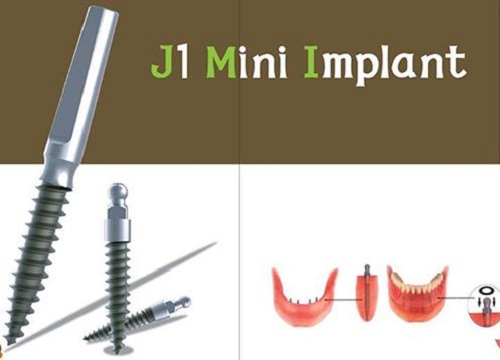 Công nghệ Mini Implant hiện đại có khả năng thay thế implant truyền thống
