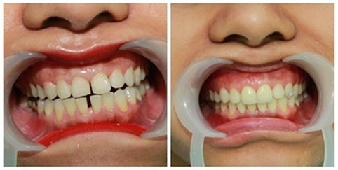 Trám răng thưa thẩm mỹ: Giải pháp nha khoa hữu hiệu