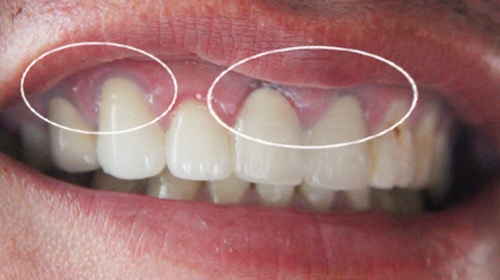 Phân tích hiện tượng viền nướu bị đen sau khi bọc răng sứ
