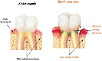 Bệnh lý răng miệng người Việt thường mắc phải