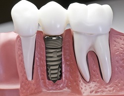 Bí quyết chăm sóc răng đúng cách sau khi cấy ghép răng implant