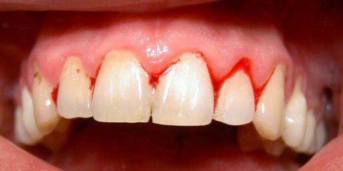 Biểu hiện và cách chữa trị viêm chân răng