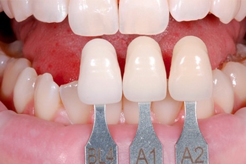 Bọc răng sứ có tốt không và ảnh hưởng đến ăn nhai như thế nào?