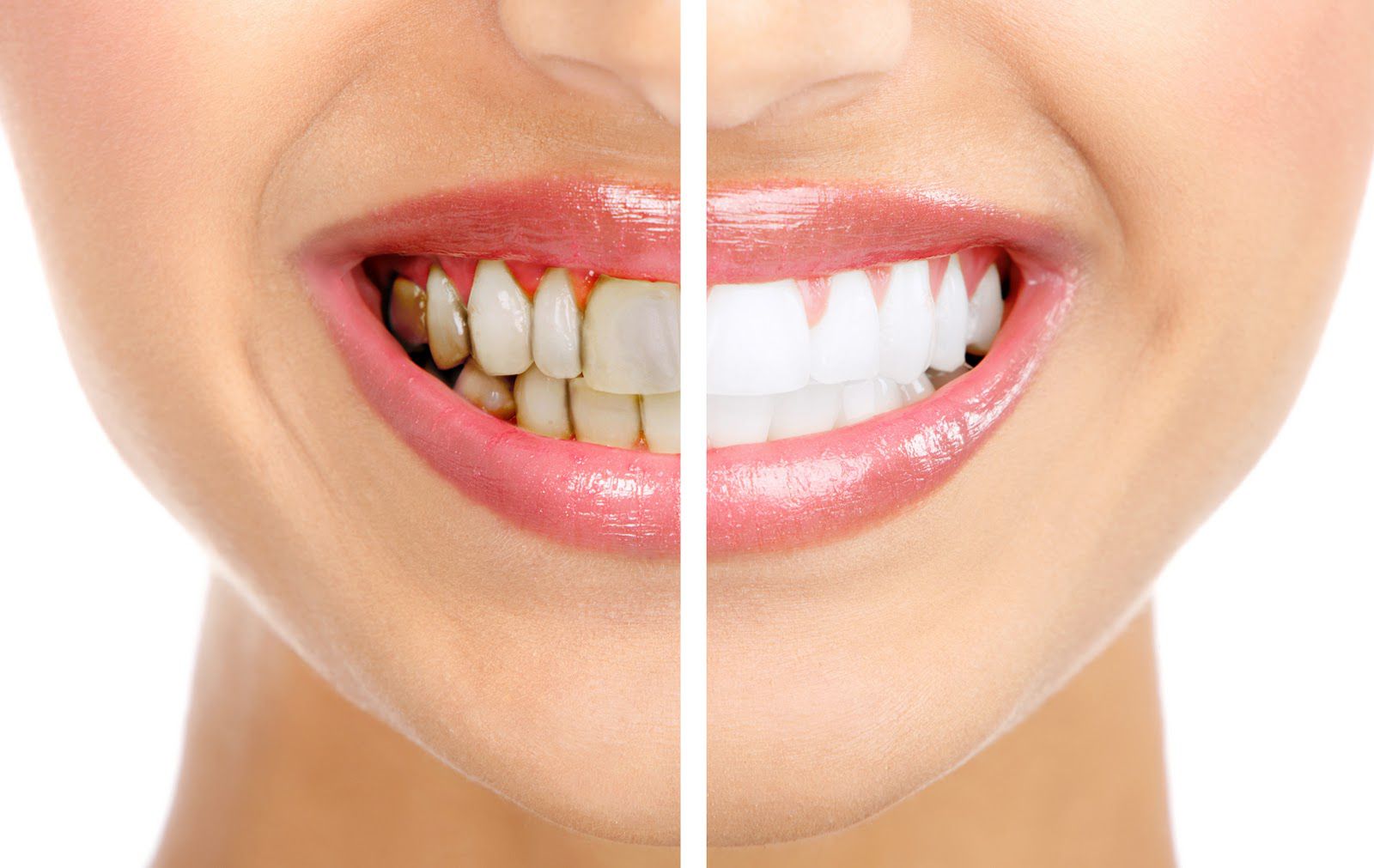 Bọc răng sứ đột phá trong lĩnh vực thẩm mỹ răng