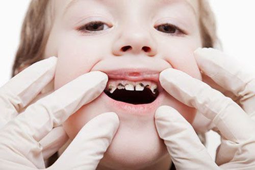 Các bệnh về răng miệng phổ biến hiện nay