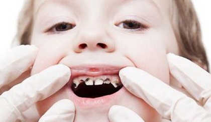 Cẩm nang chăm sóc răng sữa cho trẻ