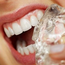 Chăm sóc răng implant sau phục hình như thế nào?