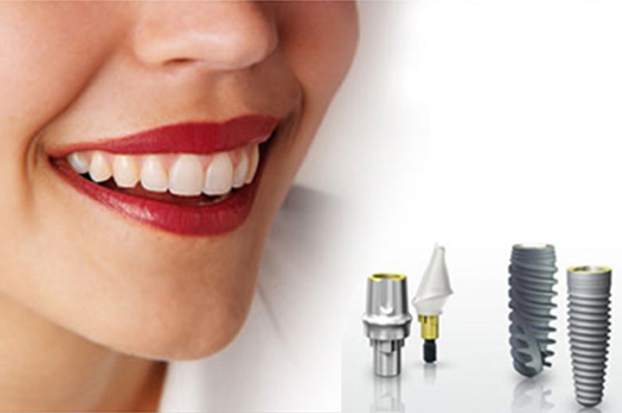 Chi phí cấy ghép implant có đắt không?