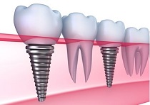 Chi phí cấy ghép Implant tại sao lại cao