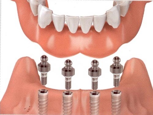 Có nên thực hiện phương pháp trồng răng implant
