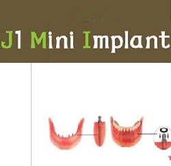 Công nghệ Mini Implant hiện đại có khả năng thay thế implant truyền thống