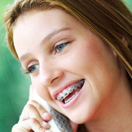 Đặc điểm và cách niềng răng hô hàm trên