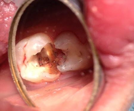 Điều trị tủy răng bằng máy vi phẫu hiện đại