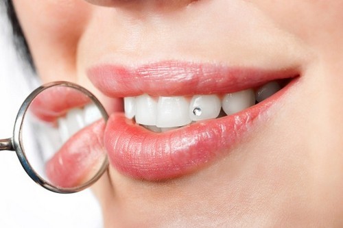 Đính đá vào răng có hại hay không?