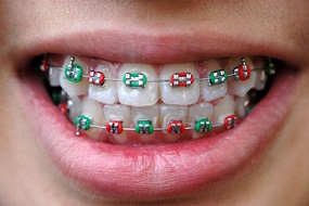 Giái pháp niềng răng hiệu quả tối ưu với mắc cài 3M UGSL