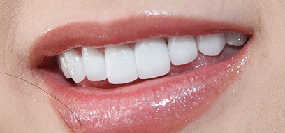 Khi bọc răng sứ cần lưu ý những điều gì?