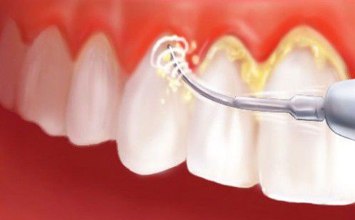 Lấy cao răng bằng máy siêu âm phương pháp thẩm mỹ răng mới