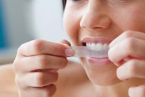 Miếng dán làm trắng răng và những điều cần biết