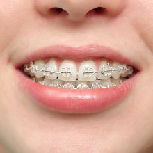 Nhổ răng khi niềng răng có cần thiết không?