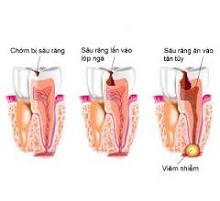Nhóm thuốc điều trị viêm tuỷ răng