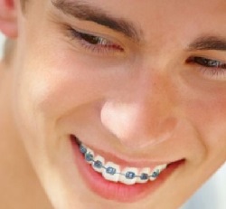 Những điều nên biết trước khi niềng răng