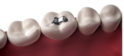 Những lưu ý khi trám răng bằng vật liệu Amalgam