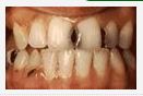 Những nguyên nhân chính dẫn tới sâu răng