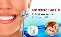 Những thắc mắc thường gặp về răng đính đá