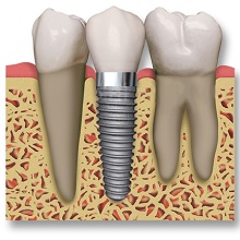 Những trường hợp được cấy ghép implant nha khoa