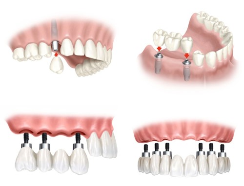 Những ưu điểm của phương pháp cấy ghép Implant