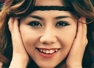 Niềng 2 răng khểnh mất thời gian bao lâu