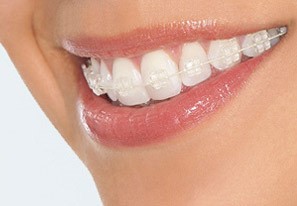 Niềng răng, giải pháp thẩm mỹ răng hiệu quả