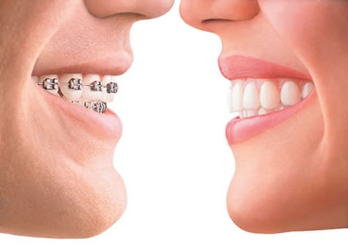 Niềng răng cho người lớn, phương pháp thẩm mỹ răng hô