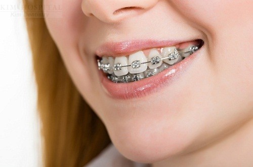Niềng răng có ảnh hưởng gì tới sinh hoạt và sức khỏe hay không?