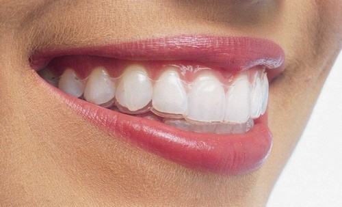 Niềng răng hiệu quả mà không cần nhổ răng