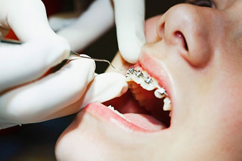 Niềng răng một hàm dưới có được hay không?