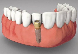 Phân biệt giữa cấy ghép răng implant và trồng răng sứ