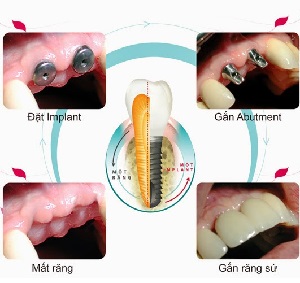 Phục hình cấy ghép Implant mất bao lâu để hoàn thành?