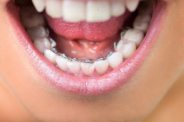 Phương Pháp niềng răng 'bí mật' ưu và nhược điểm